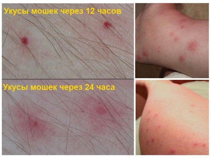 Укусы мошек